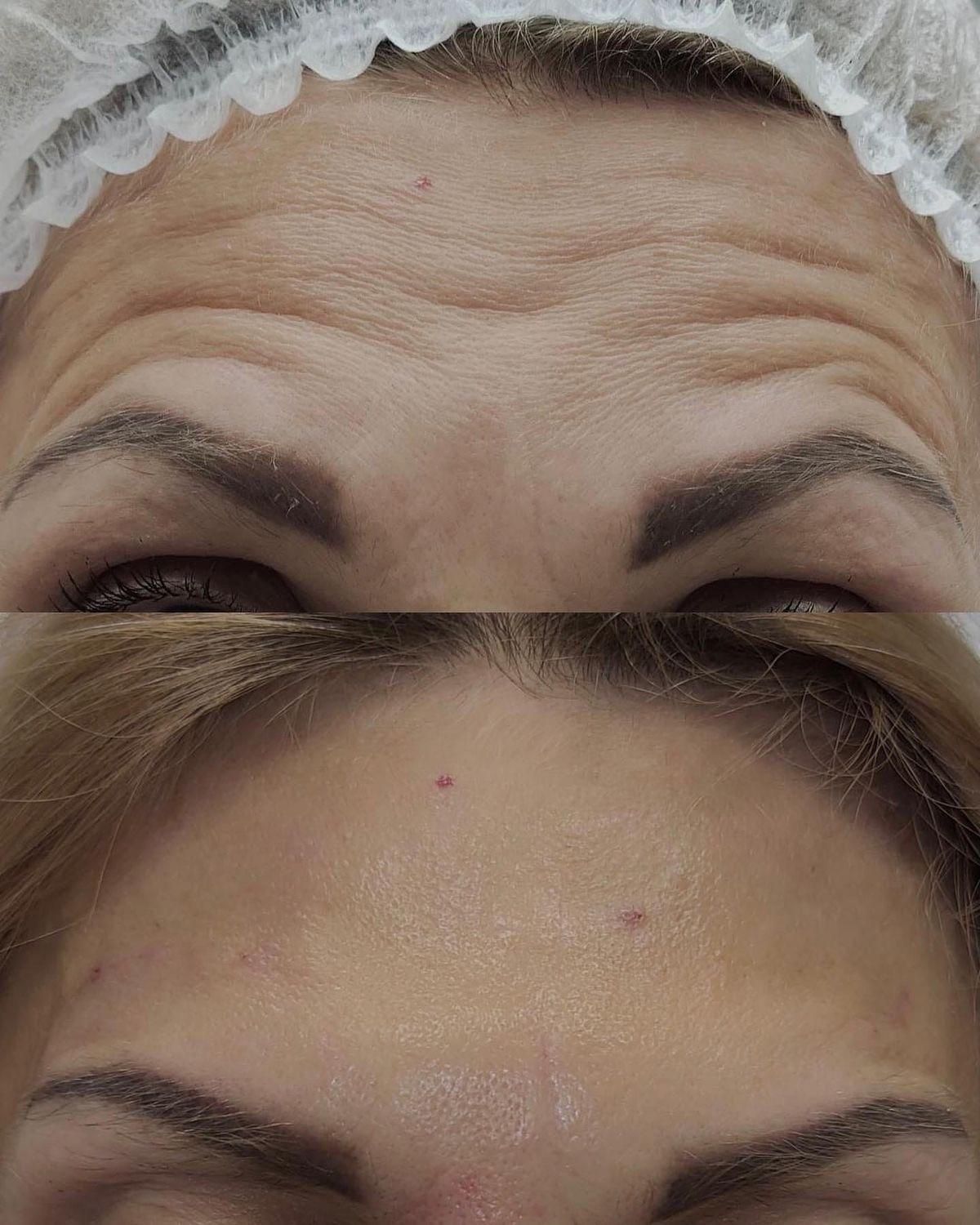 فیلر زیر چشم،ژل ،بوتاکس ،خدمات جوانسازی صورت|خدمات آرایشگری و زیبایی|اندیشه, اندیشه فاز ۱|دیوار