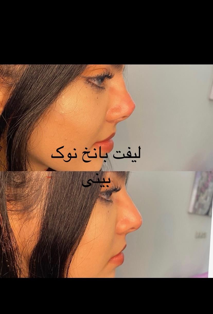 بوتاکس صورت ومعده ژل تزریق چربی عمل پلک ساکشن غبغب|خدمات آرایشگری و زیبایی|یزد, |دیوار