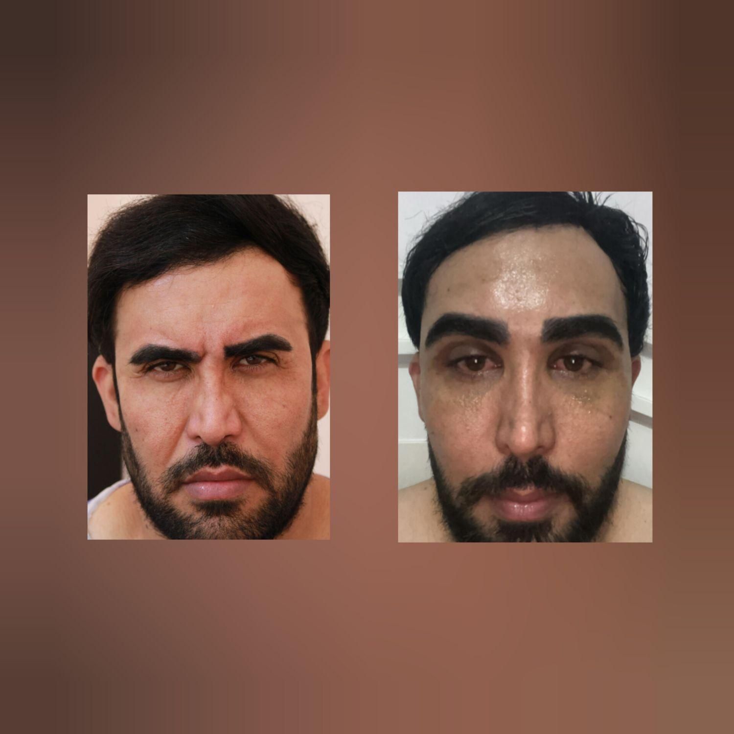 جشنواره پایان تابستان جراحی لیفت صورت پیشانی|خدمات آرایشگری و زیبایی|تهران, ظفر|دیوار