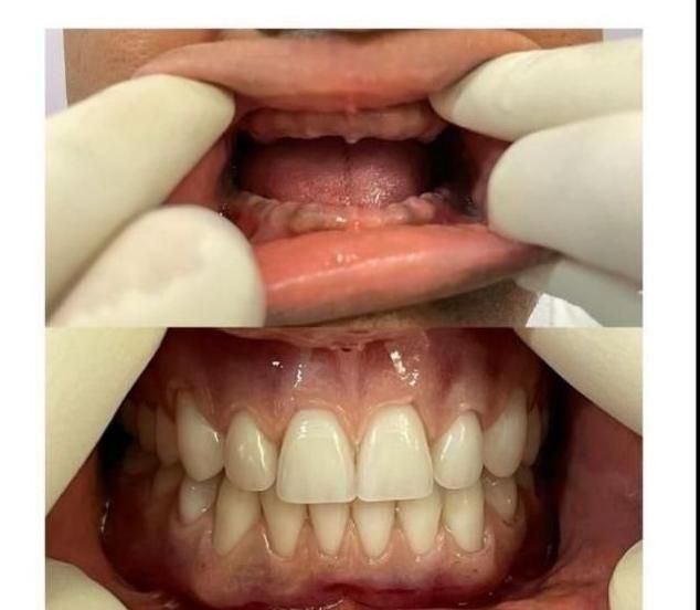 دندان مصنوعی(بدون واسطه خرید کن)|خدمات آرایشگری و زیبایی|قرچک, باقرآباد|دیوار