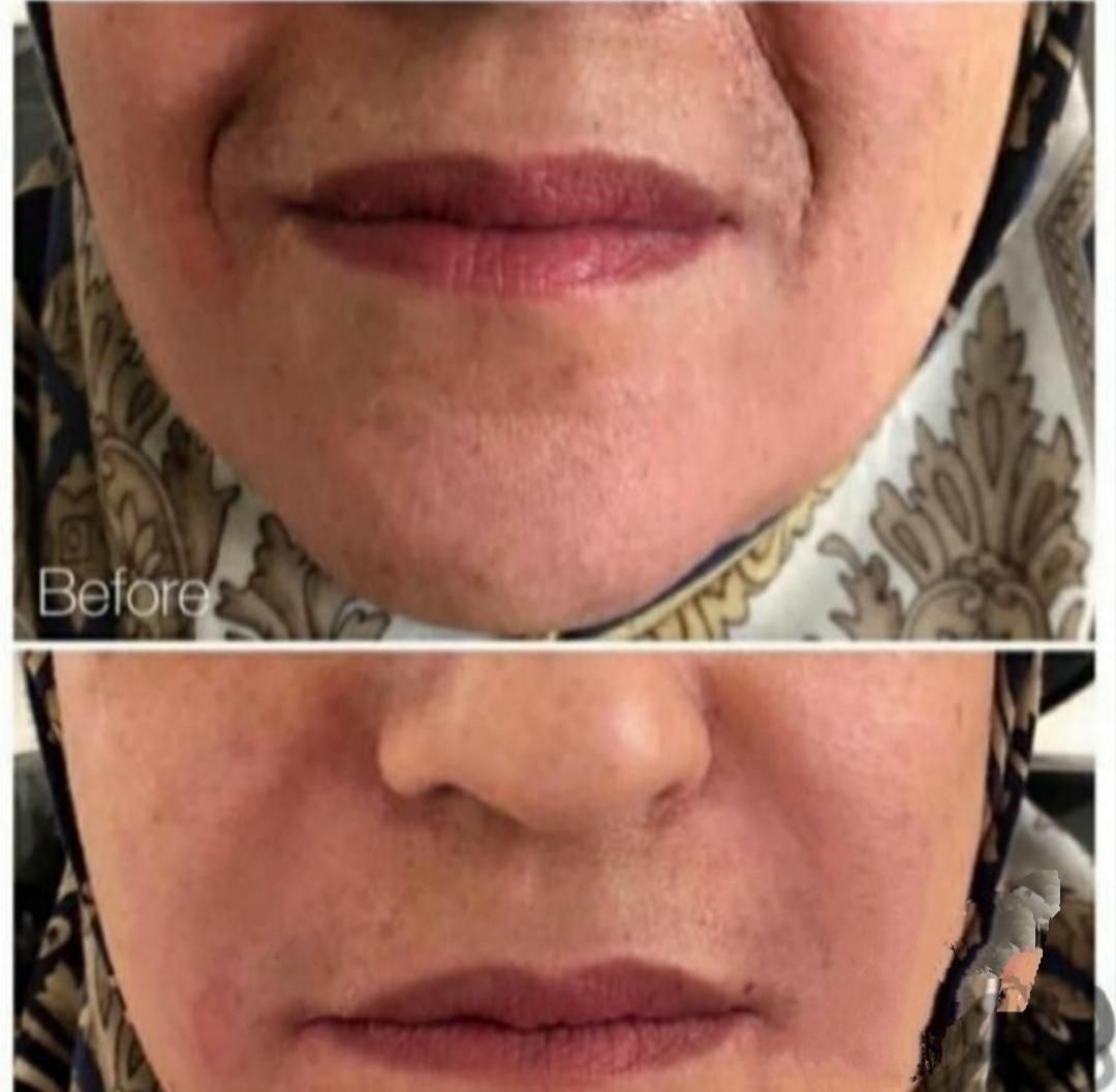 بوتاکس وتزریق ژل لیفت نخ بلفاروساکشن وکاشت مو|خدمات آرایشگری و زیبایی|مشهد, آزادشهر|دیوار