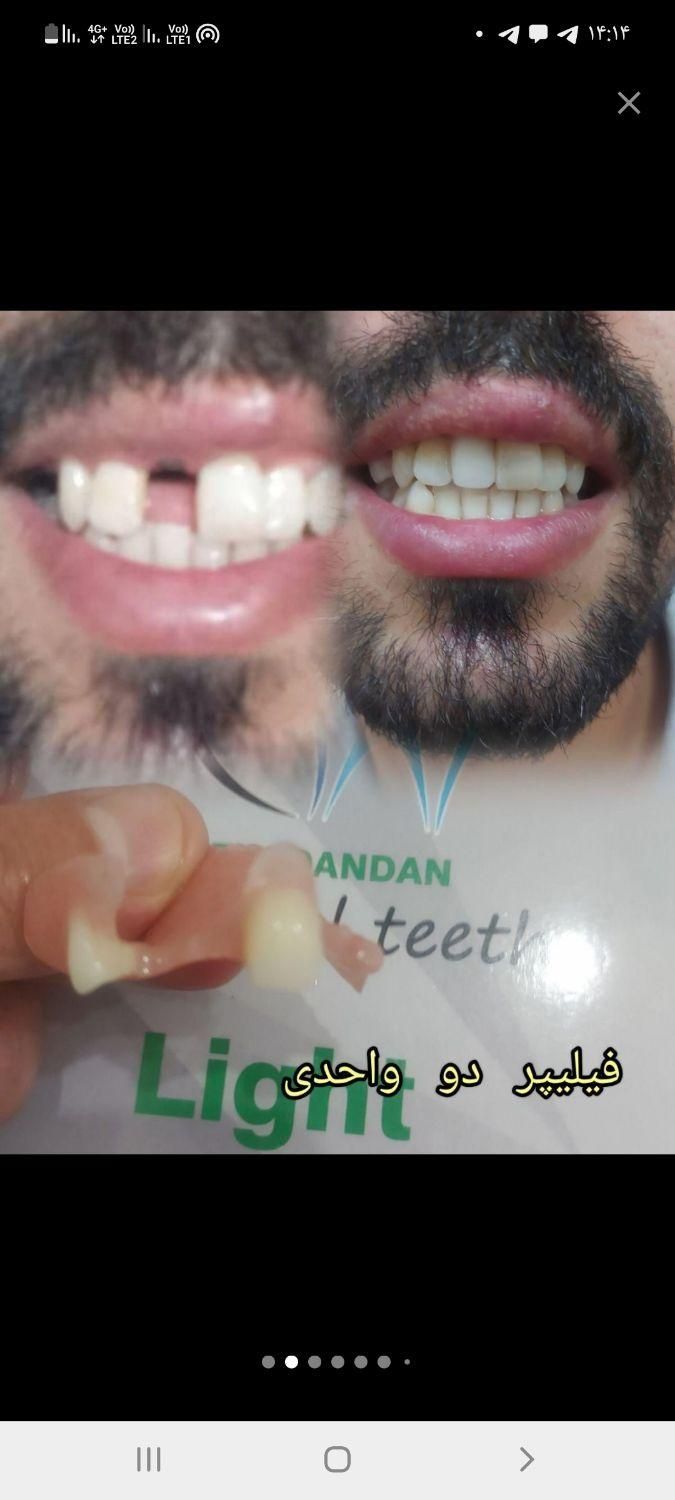 دندان مصنوعی متحرک جایگزین ایمپلنت بصورت آنی|آرایشی، بهداشتی، درمانی|رشت, گلسار|دیوار