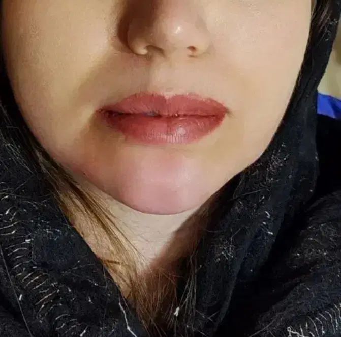 بوتاکس مصپورت.تزریقات وپانسمان و سوراخ کردن گوش|خدمات آرایشگری و زیبایی|اراک, |دیوار