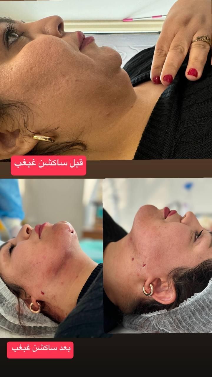 حذف پف پلک و افتادگی بوتاکس،ژل،بوکال،سانترال،هایفو|خدمات آرایشگری و زیبایی|تبریز, |دیوار