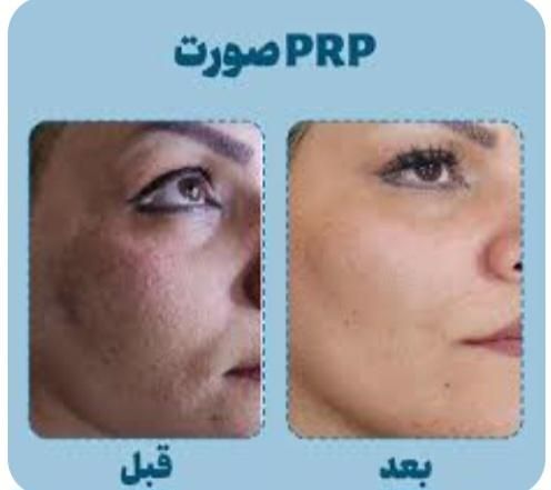 تتو ابر‌و میکروبلیدینگ شیدینگ ژل ومزو و وپی ارپی|خدمات آرایشگری و زیبایی|شوشتر, |دیوار