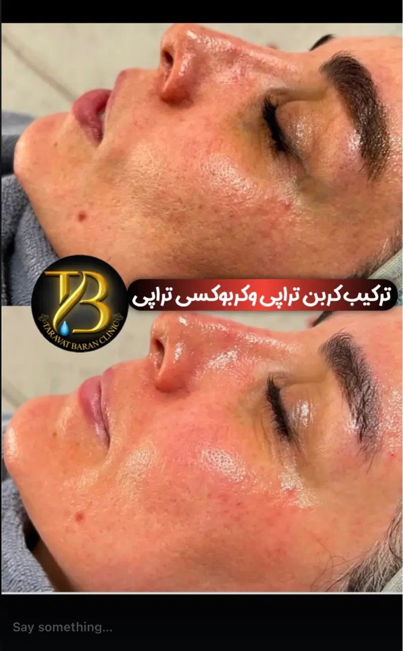 روشن‌کننده هایفو لیزرموزائد پی‌آر‌پی حجم‌سینه‌باسن|خدمات آرایشگری و زیبایی|تهران, صادقیه|دیوار