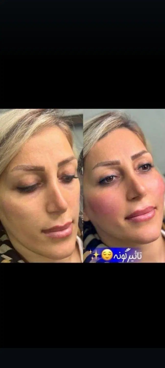 فیلر بوتاکس لیزر فیلربادی لاغری مزوتراپی prp جراحی|خدمات آرایشگری و زیبایی|مشهد, هنرستان|دیوار