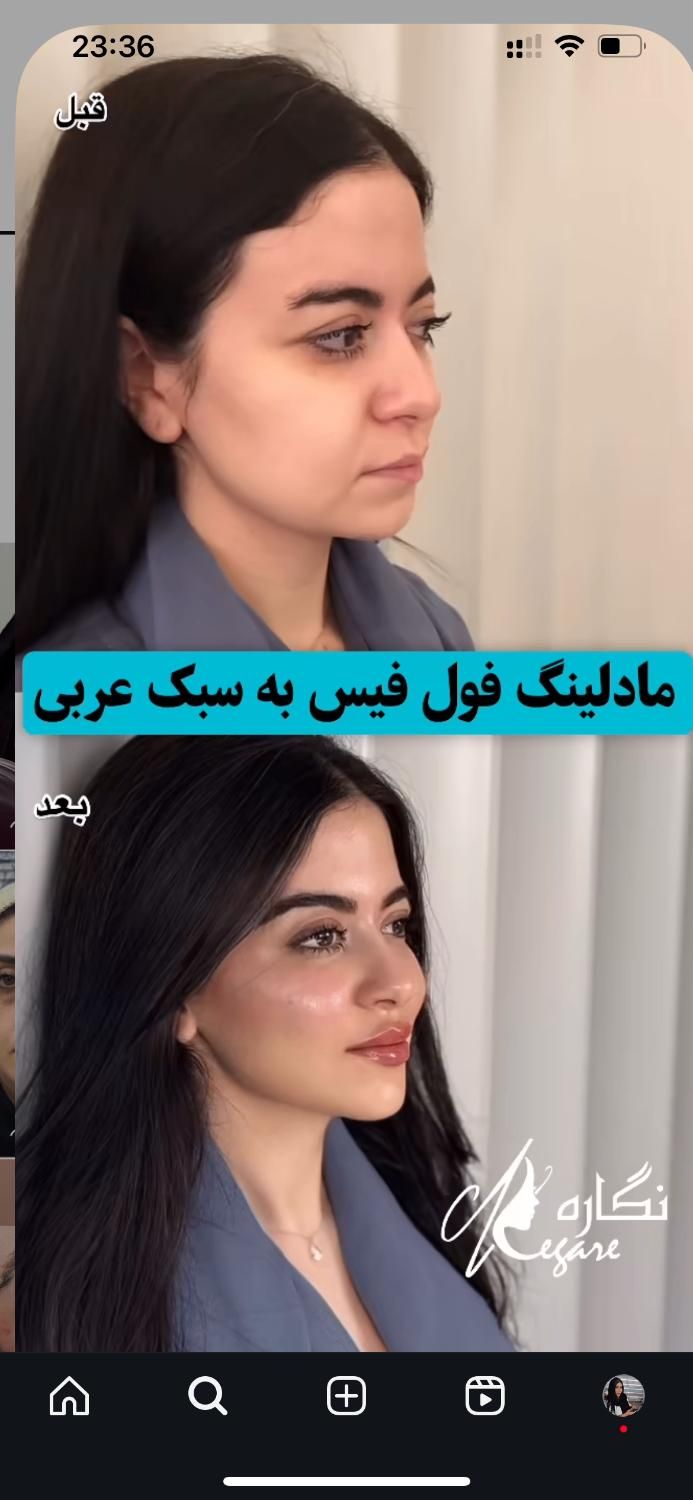 مزو،بوتاکس،چربی،فیلر،جراحی زیبایی صورت وبدن|خدمات آرایشگری و زیبایی|تهران, نارمک|دیوار