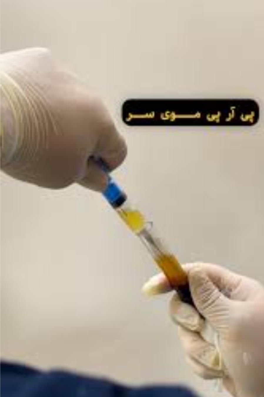 prp پی ارپی مو صورت... مطب دکتر صادقیه|خدمات آرایشگری و زیبایی|تهران, فردوس|دیوار