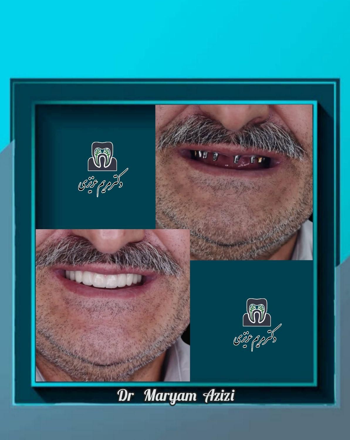 ایمپلنت دندان پزشکی تعرفه دولتی دندانپزشکی تضمینی|خدمات آرایشگری و زیبایی|شیراز, معالی‌آباد|دیوار