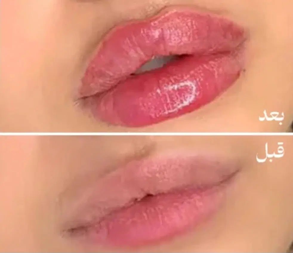 ژل و بوتاکس فیلر مزو ژل مزو تخفیف ویژه فول فیس|خدمات آرایشگری و زیبایی|مشهد, ملک‌آباد|دیوار