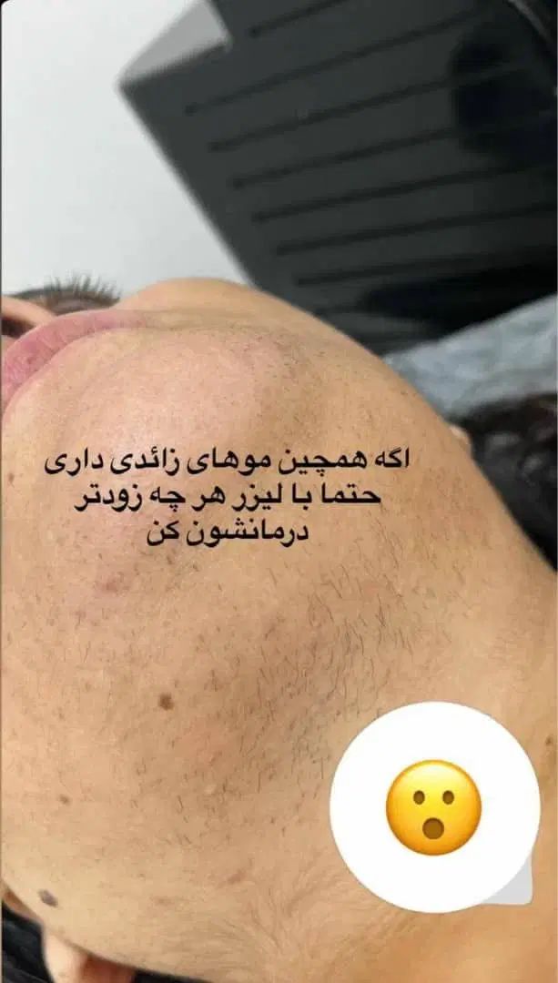 فیشال بوتاکس مزو پی آر پی لیزر بدن prp پی ارپی|خدمات آرایشگری و زیبایی|مشهد, هفت تیر (حافظ)|دیوار