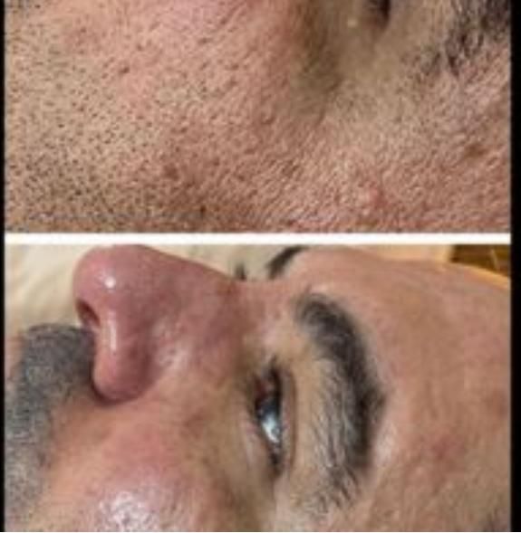 جشنواره پاک کردن تتو با لیزر و کربن تراپی پوست|خدمات آرایشگری و زیبایی|زنجان, |دیوار
