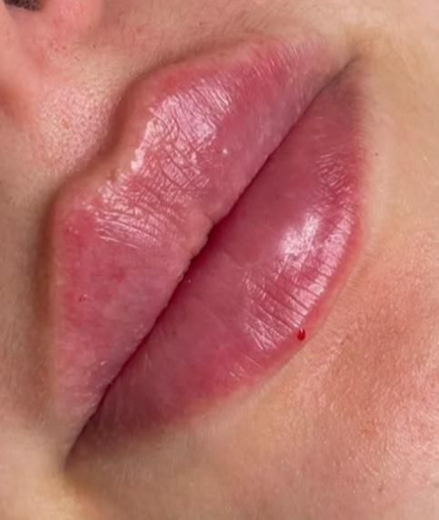 تزریق ژل و بوتاکس|خدمات آرایشگری و زیبایی|بندر کنگان, |دیوار