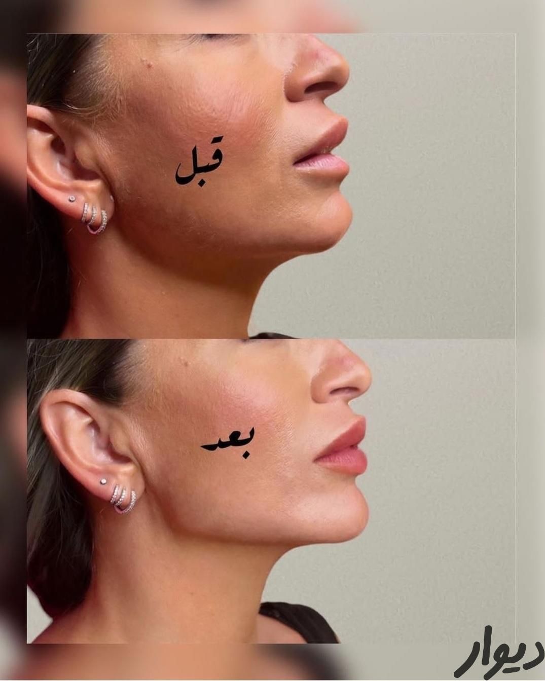 ٪50 آفر مزو prp بوتاکس فیلرلب زاویه سازی فیلر چانه|خدمات آرایشگری و زیبایی|مشهد, وکیل‌آباد|دیوار