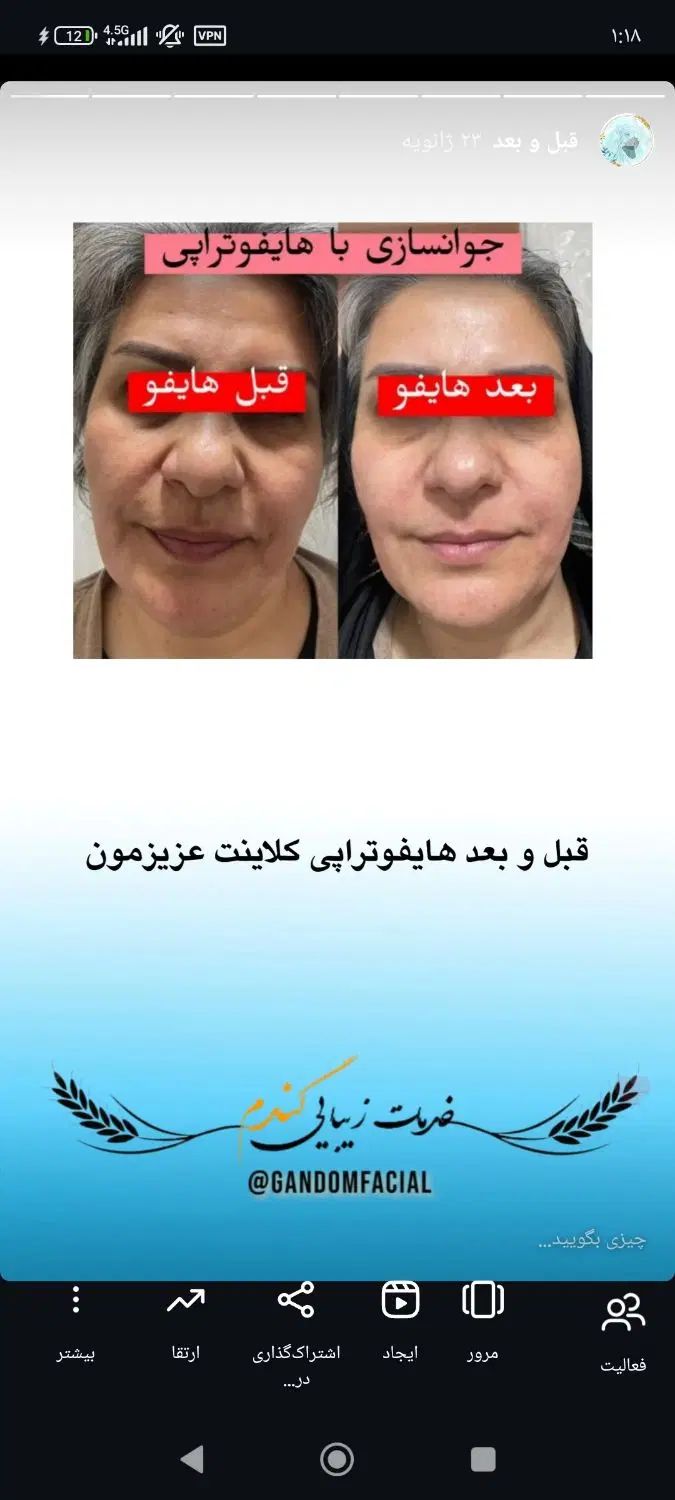 پاکسازی جوانسازی پوست و خالبرداری و مزو و بوتاکس|خدمات آرایشگری و زیبایی|سمنان, |دیوار