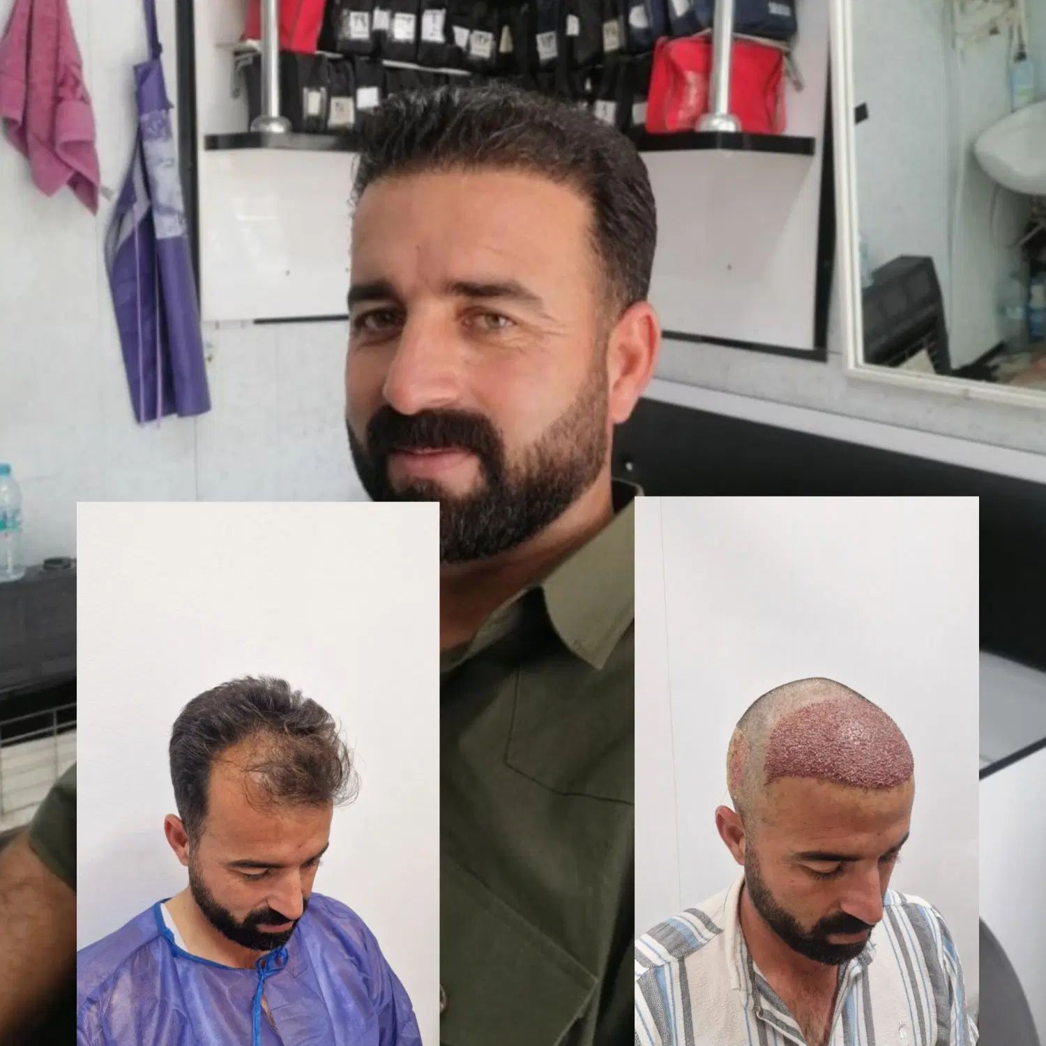 کاشتمو تضمینی و تراکم عالی زیر نظر پزشک|خدمات آرایشگری و زیبایی|مشهد, فردوسی|دیوار