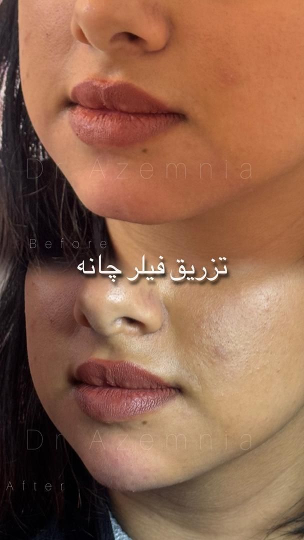 ژل ،بوتاکس لیزر مو رفع تتو پاکسازی هایفو توسط پزشک|خدمات آرایشگری و زیبایی|پرند, فاز ۲|دیوار