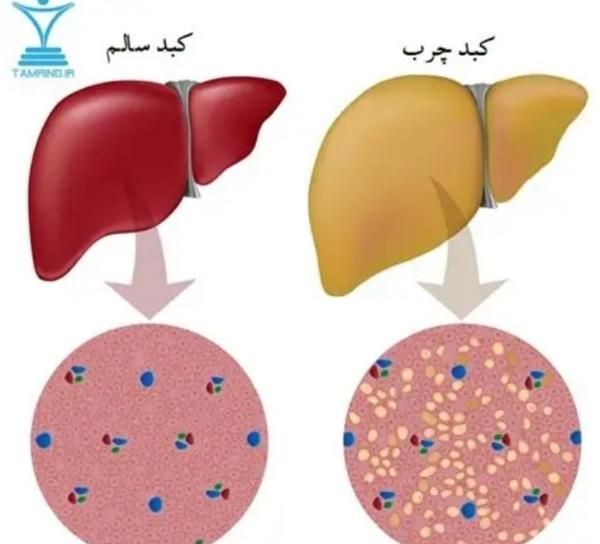 کبدچرب/کیست فیبروم /تنبلی تخمدان/تیروئید|آرایشی، بهداشتی، درمانی|گرگان, |دیوار
