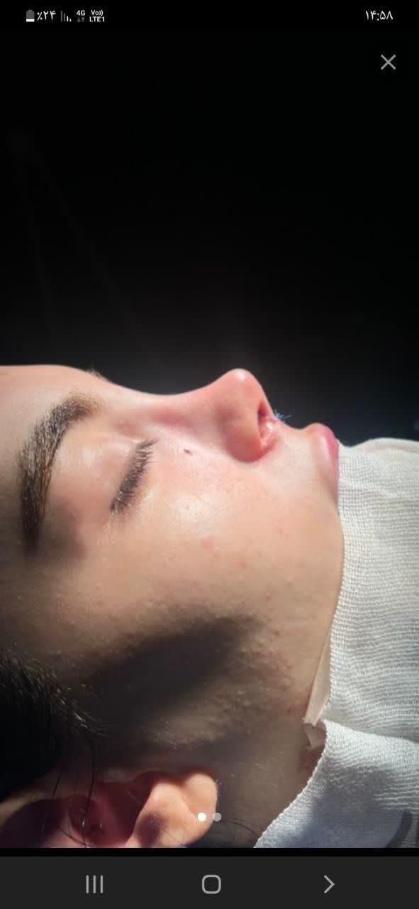 جراحی و عمل زیبایی بینی ( رینو پلاستی )|خدمات آرایشگری و زیبایی|کرج, گوهردشت|دیوار