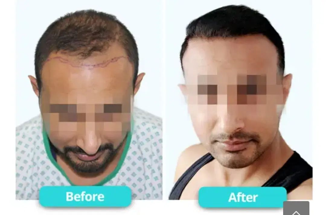 کاشت مواقساطی ویژه شهریور|خدمات آرایشگری و زیبایی|رشت, بوسار|دیوار