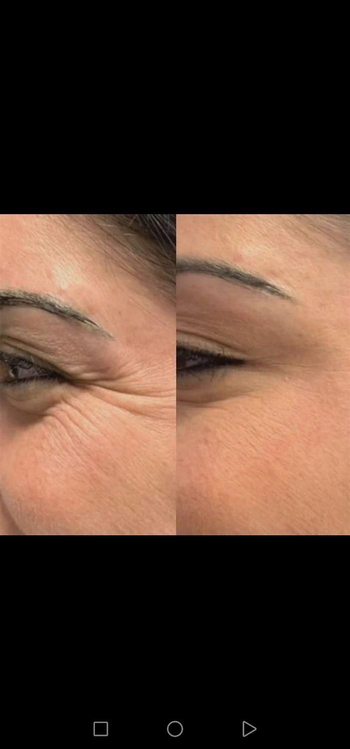جشنواره تخفیف تزریق تخصصی ژل و بوتاکس|خدمات آرایشگری و زیبایی|شیراز, محراب|دیوار