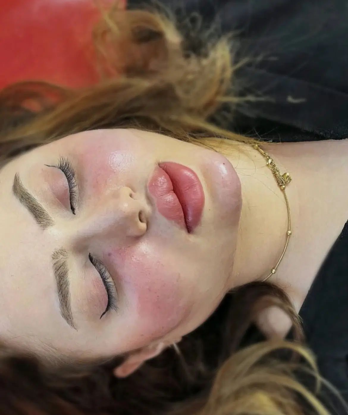 تزریق تخصصی فیلروبوتاکس و آنزیم توسط پزشک|خدمات آرایشگری و زیبایی|کرمانشاه, |دیوار
