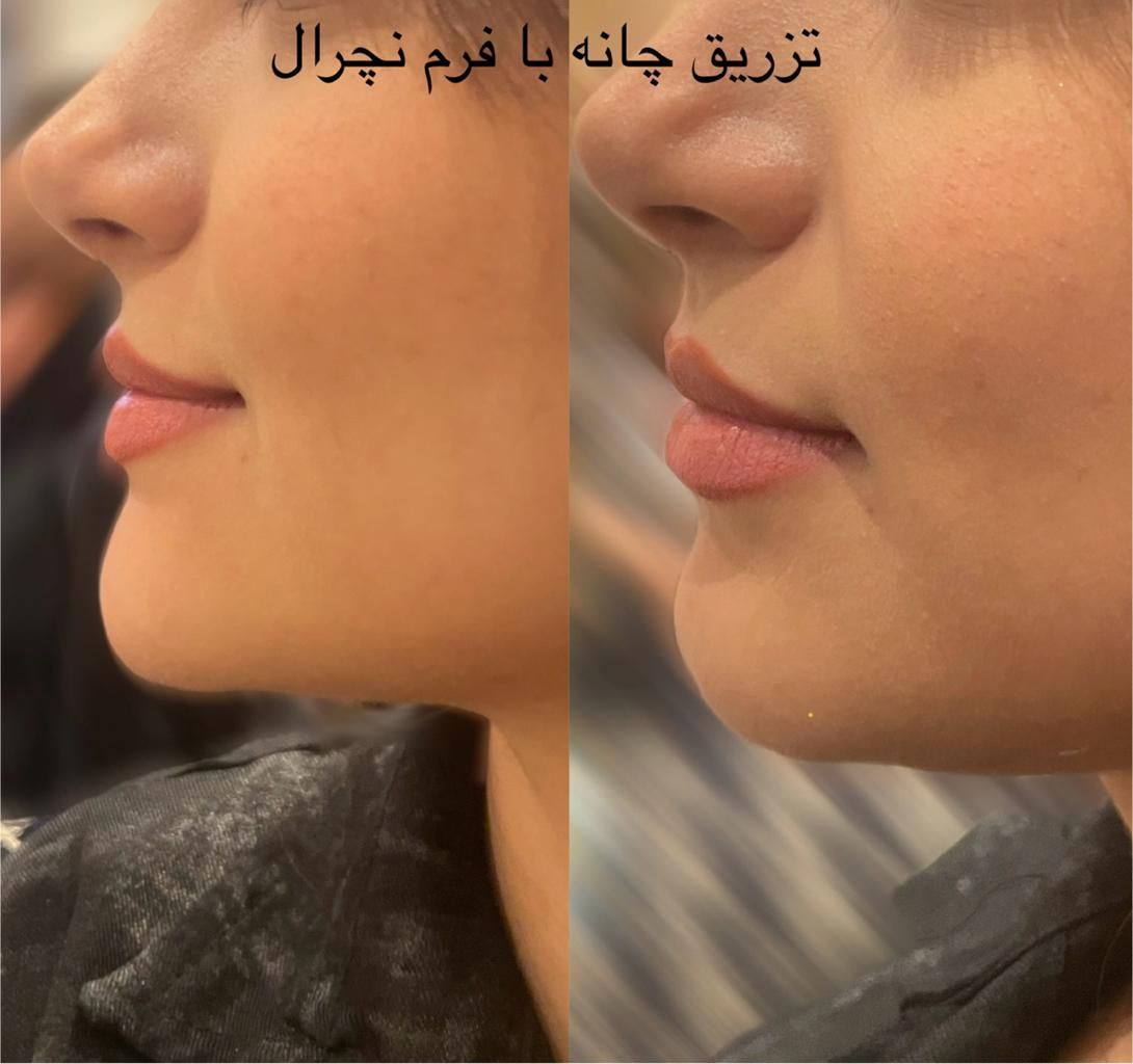 بوتاکس ، فیلر کل صورت ، مزو تراپی ، خال برداری|خدمات آرایشگری و زیبایی|اردبیل, |دیوار