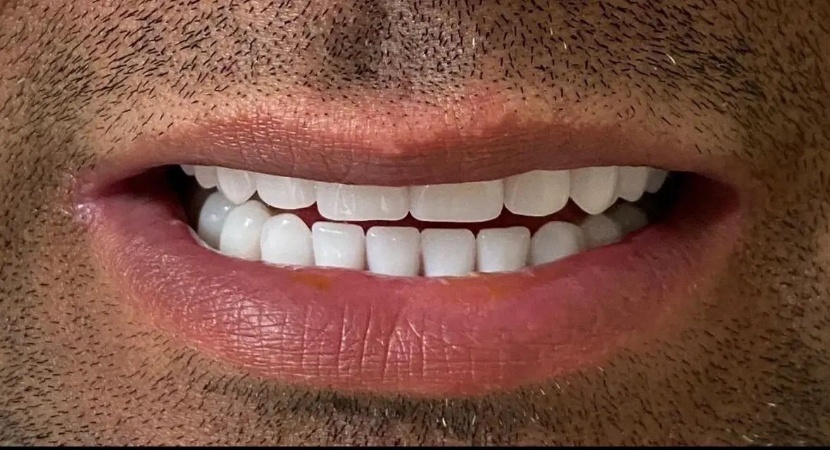 دندان مصنوعی تخصص ماست ( اقساط )|خدمات آرایشگری و زیبایی|اصفهان, لاله|دیوار