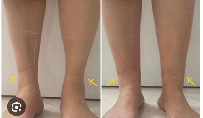 تزریق فیلرهای بدن(دست-مچ پا-باسن)ساکشن غبغپ|خدمات آرایشگری و زیبایی|اصفهان, ملک‌شهر|دیوار