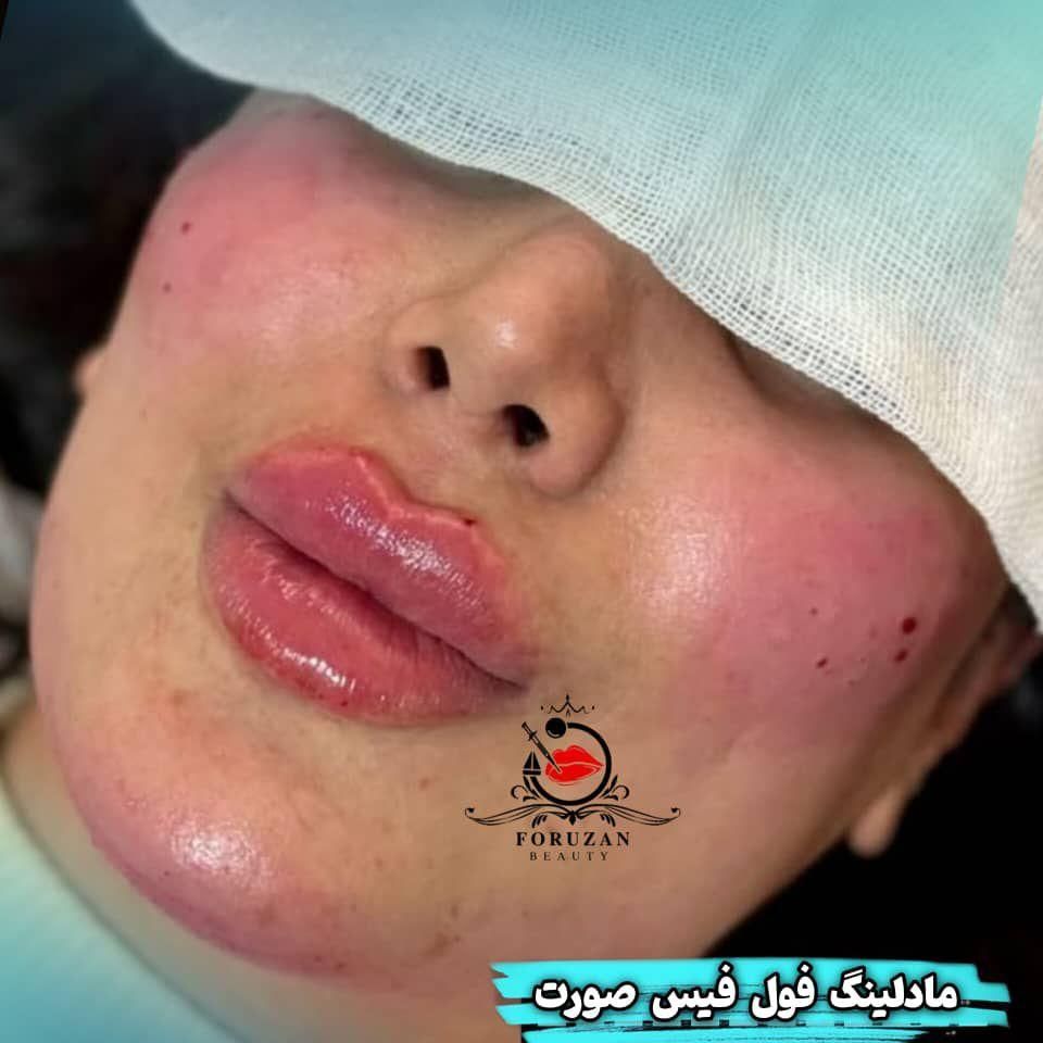 آفر(۷ روزه) ژل و بوتاکس فولادشهر|خدمات آرایشگری و زیبایی|فولادشهر, فولادشهر|دیوار