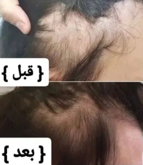 تونیک ضدریزش و رویش مجدد هیرفرند|آرایشی، بهداشتی، درمانی|تهران, نیروی هوایی (پیروزی)|دیوار