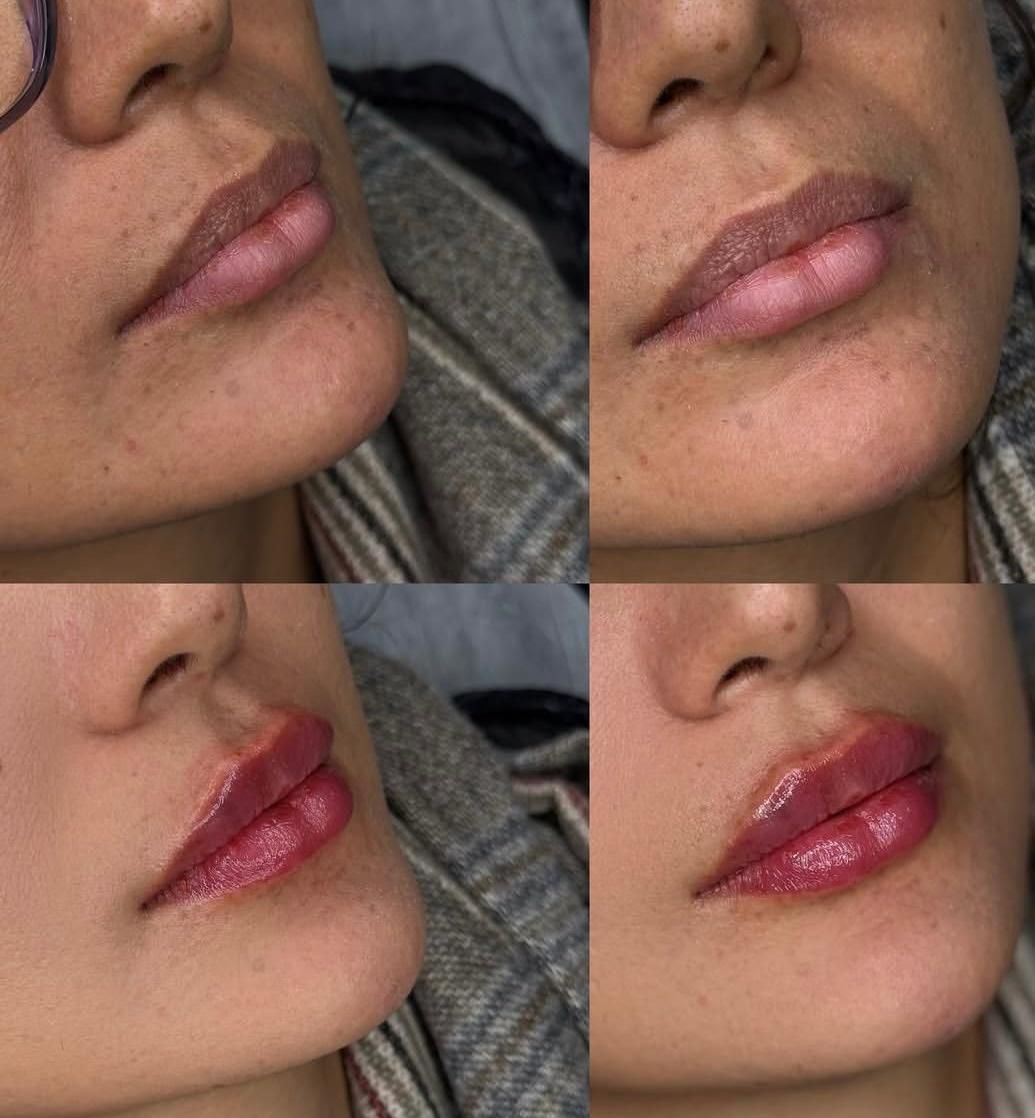 تخفیفات ژل و بوتاکس در مطب پزشک|خدمات آرایشگری و زیبایی|سنندج, |دیوار