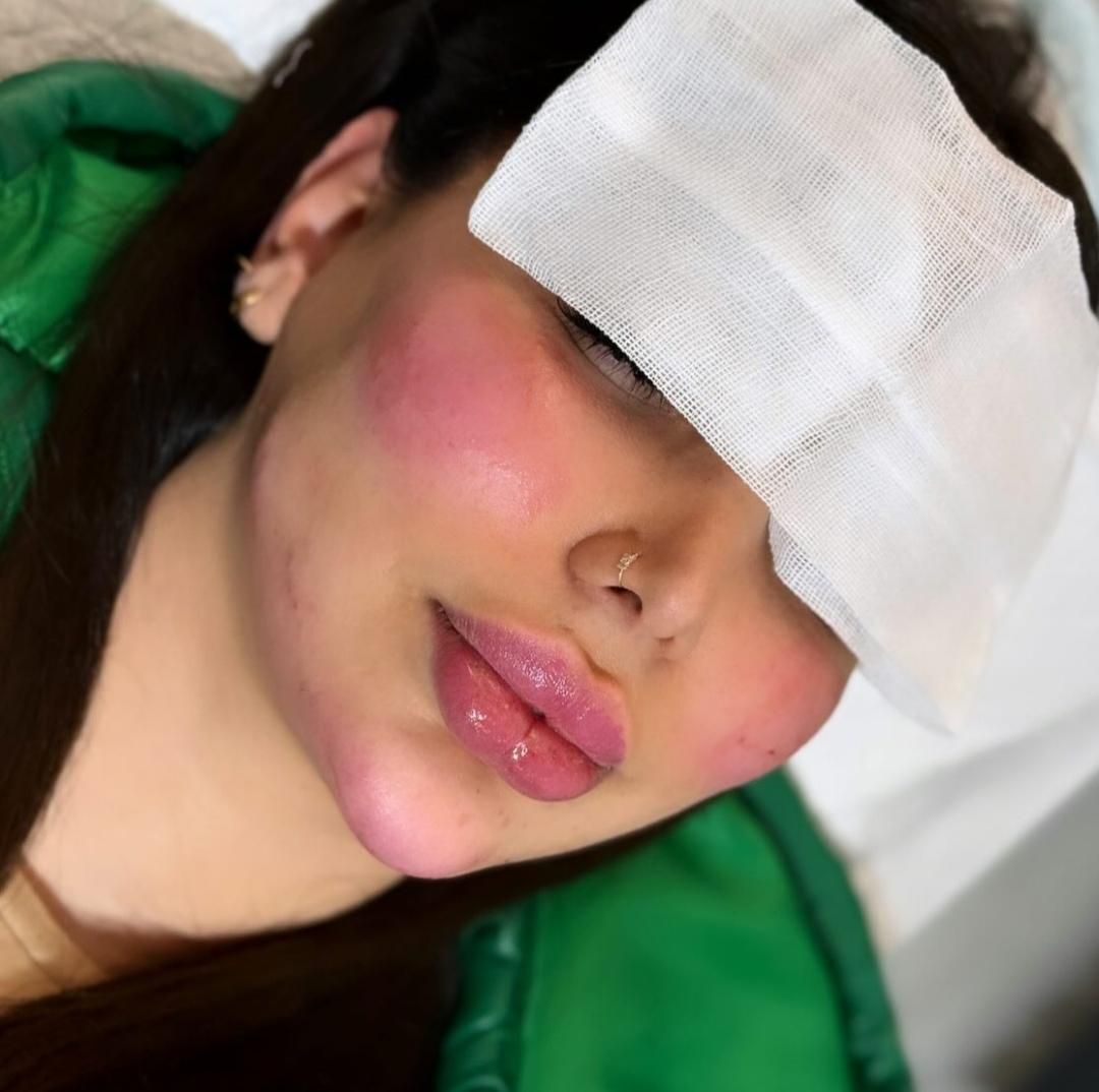 ژل بوتاکس فیلر چربی مزو جوانساز بلفارو درمطب پزشک|خدمات آرایشگری و زیبایی|کرج, گوهردشت|دیوار