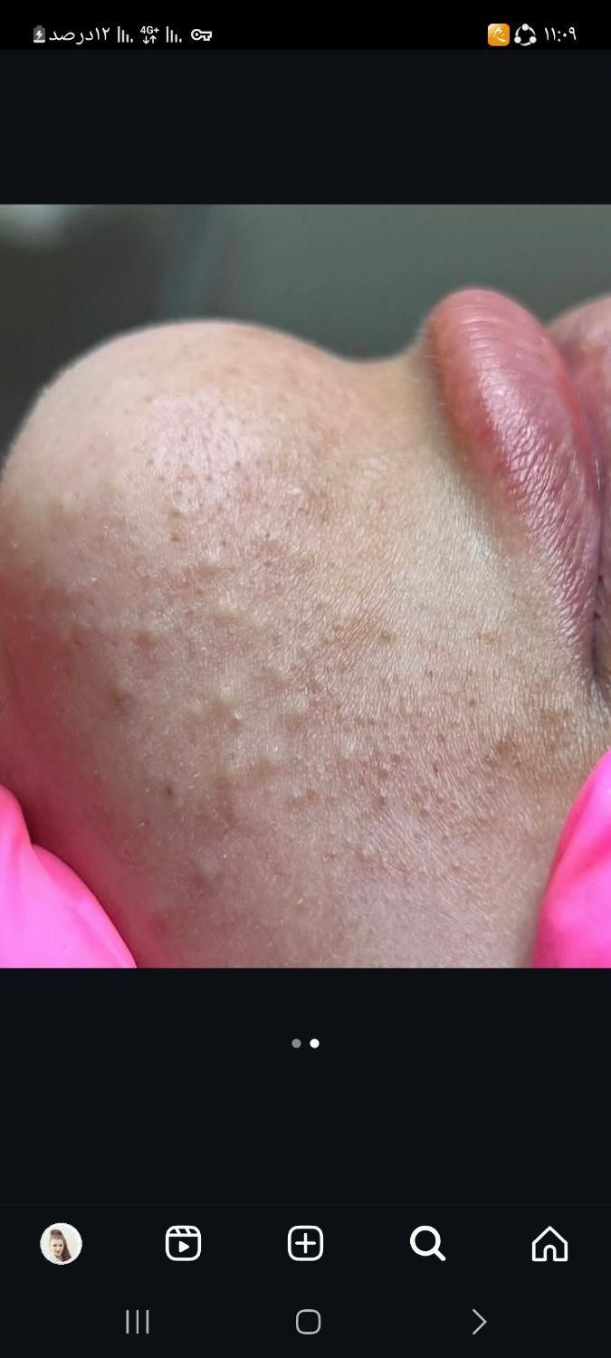 پاکسازی پوست تخفیف ویژه|خدمات آرایشگری و زیبایی|اراک, |دیوار