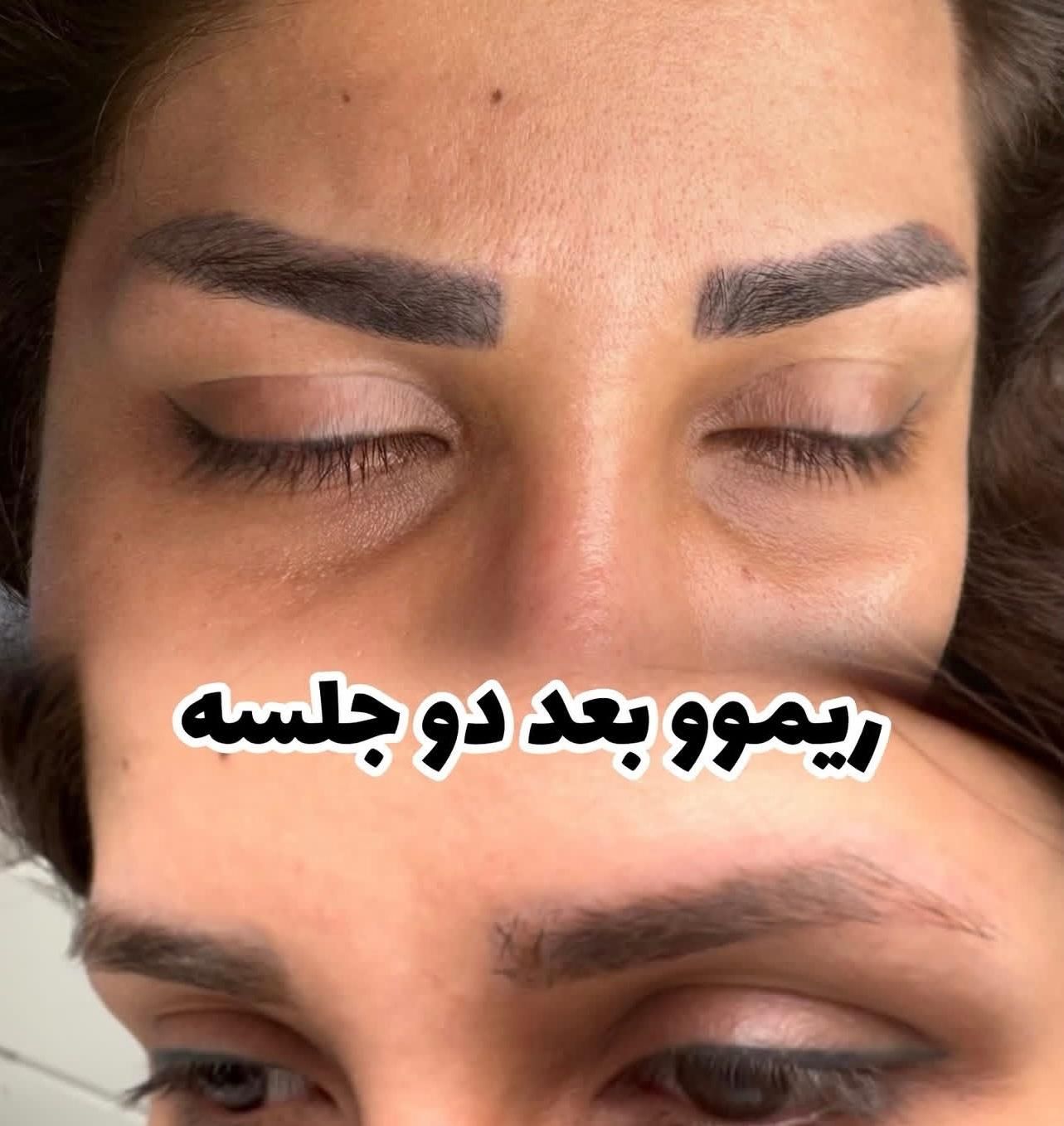 لیزر پاک کردن تتو تاتو کیوسوییچ رفع تتو ابرو و بدن|خدمات آرایشگری و زیبایی|اهواز, کیانپارس |دیوار