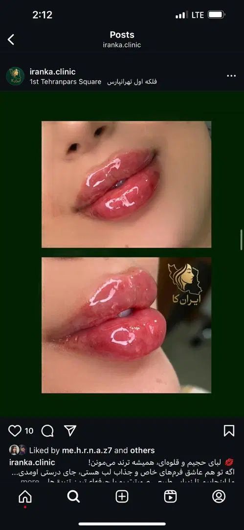 تزریق ژل وفیلر بادی و نخ و لیزر با دستگاه الکس۲۰۲۳|خدمات آرایشگری و زیبایی|تهران, تهرانپارس غربی|دیوار