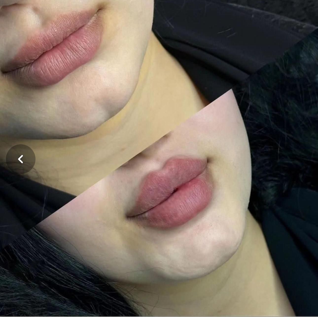 تزریق ژل لب بوتاکس زاویه سازی گونه فول فیس هایفو۲۴|خدمات آرایشگری و زیبایی|مشهد, احمدآباد|دیوار