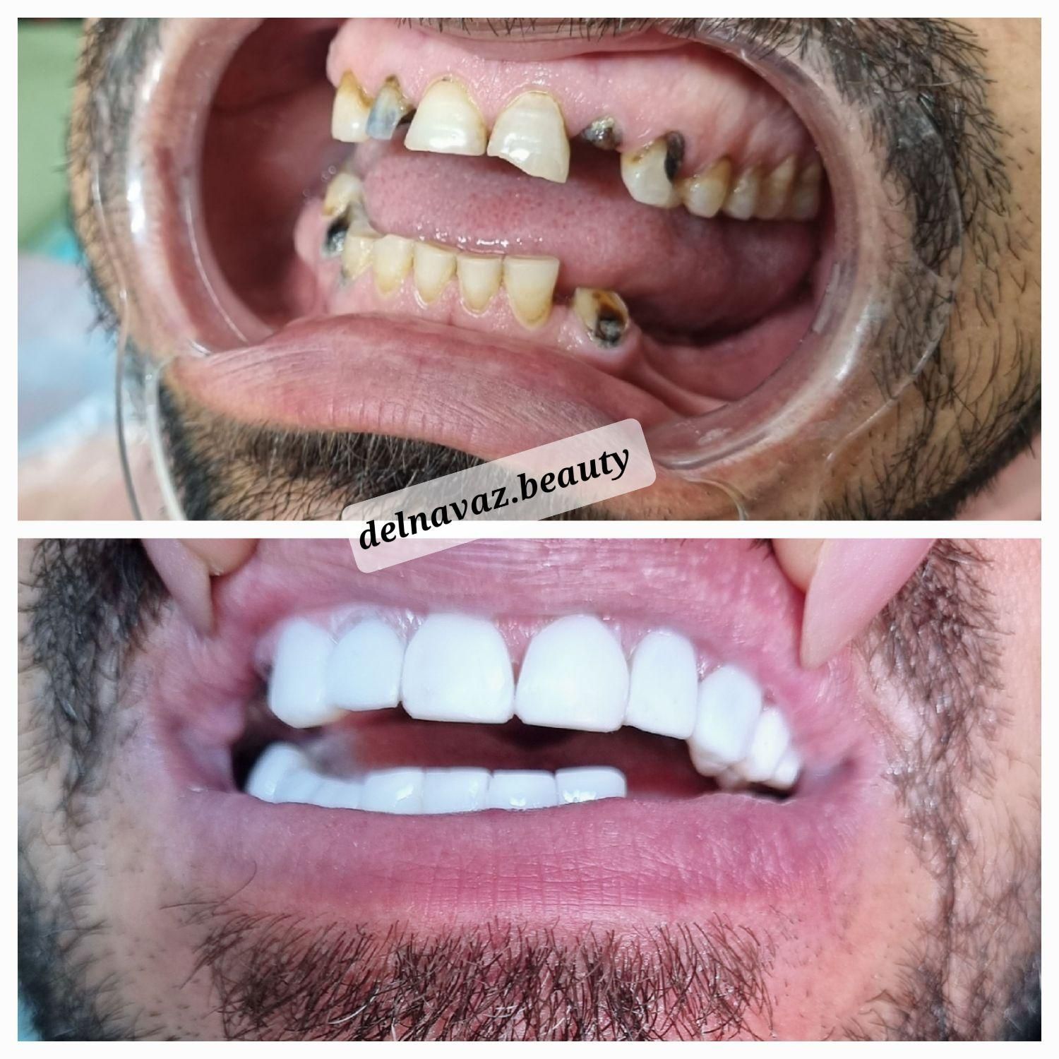 کامپوزیت دندان ژل و بوتاکس پی آرپی و لیفت نخ|خدمات آرایشگری و زیبایی|اهواز, نادری|دیوار