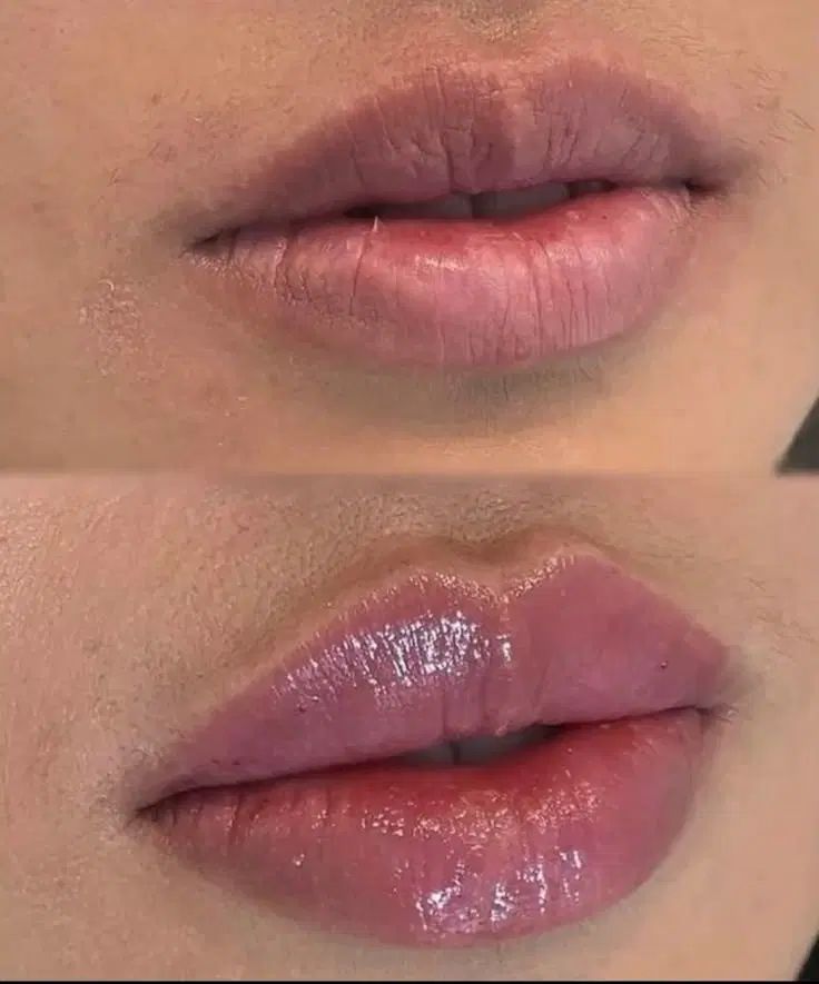 ژل،بوتاکس،مزوتراپی مو صورت،آنزیم،فیلرلب|خدمات آرایشگری و زیبایی|کرج, ساماندهی|دیوار