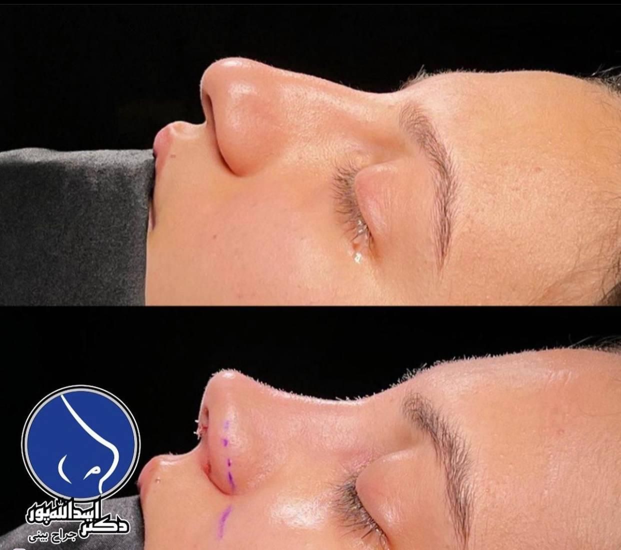 جراحی زیبایی بینی فقط با 22 ملیون|خدمات آرایشگری و زیبایی|شاهرود, |دیوار