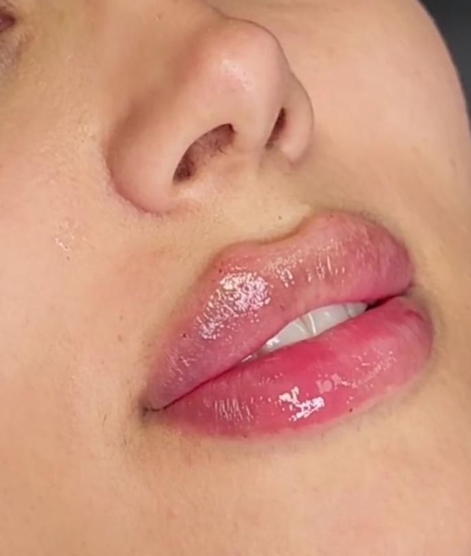 فیلر۶۰۰زیبایی صورت.لب با ژل/رفع چروک بابوتاکس۷۰۰|خدمات آرایشگری و زیبایی|برازجان, |دیوار