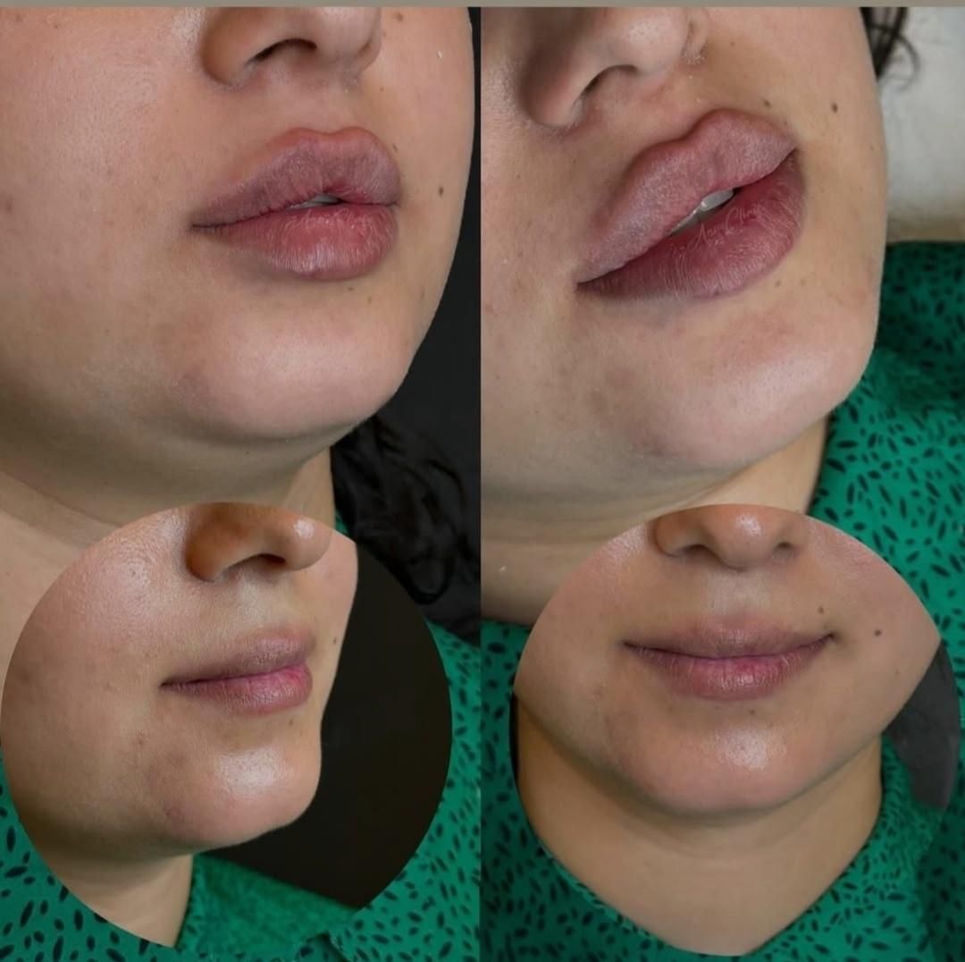 تزریق ژل لب ب روش روسی آنباکسش توسط زیباجو|خدمات آرایشگری و زیبایی|مشهد, پنجتن|دیوار
