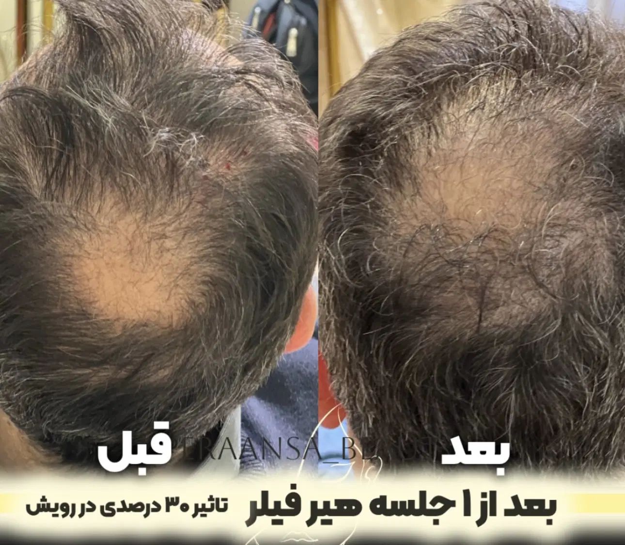 درمان ریزش مو و رویش مجدد با بهترین متریال|خدمات آرایشگری و زیبایی|تهران, امام حسین|دیوار