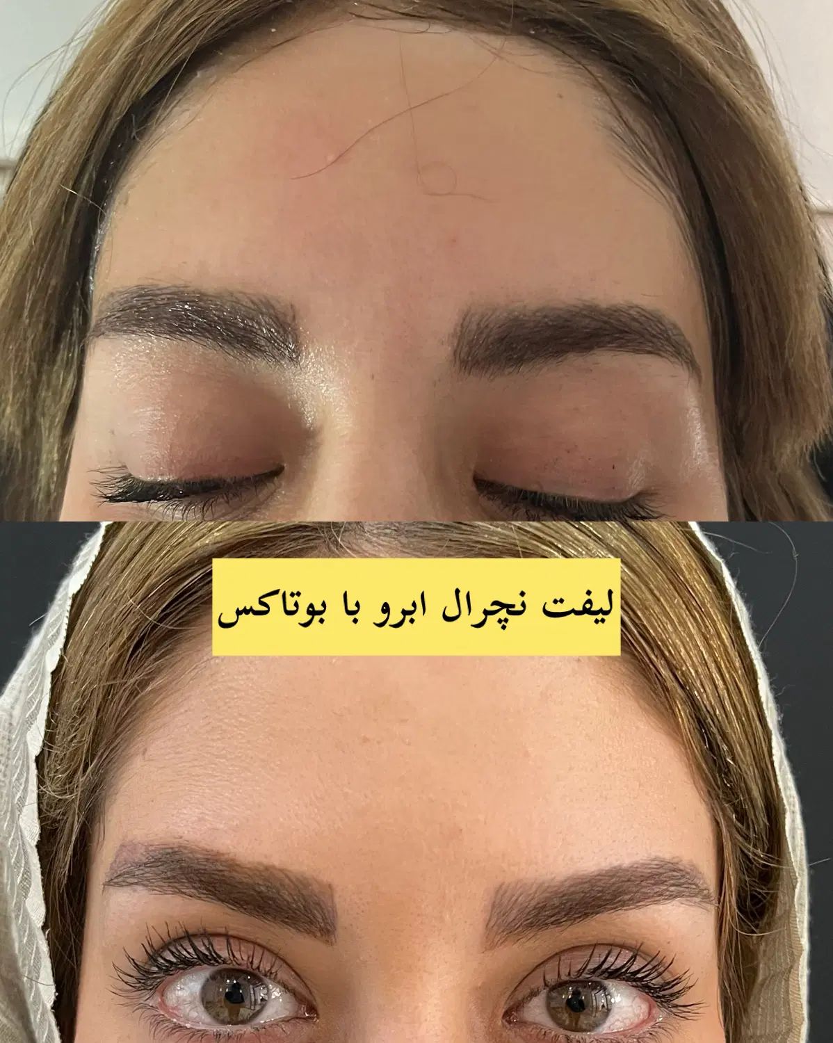 جشنواره ۶۰٪  بوتاکس فول‌فیس - برج ماندگار عظیمیه|خدمات آرایشگری و زیبایی|کرج, عظیمیه|دیوار