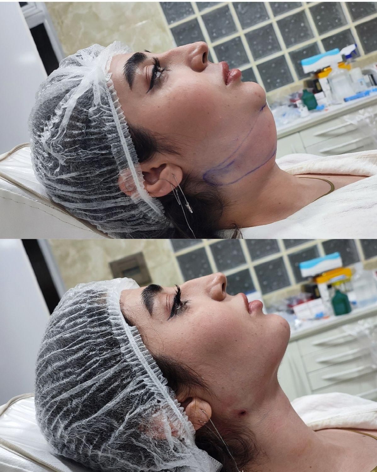 ژل بوتاکس عمل بینی ساکشن چربی در کلینیک بهنود|خدمات آرایشگری و زیبایی|تبریز, |دیوار