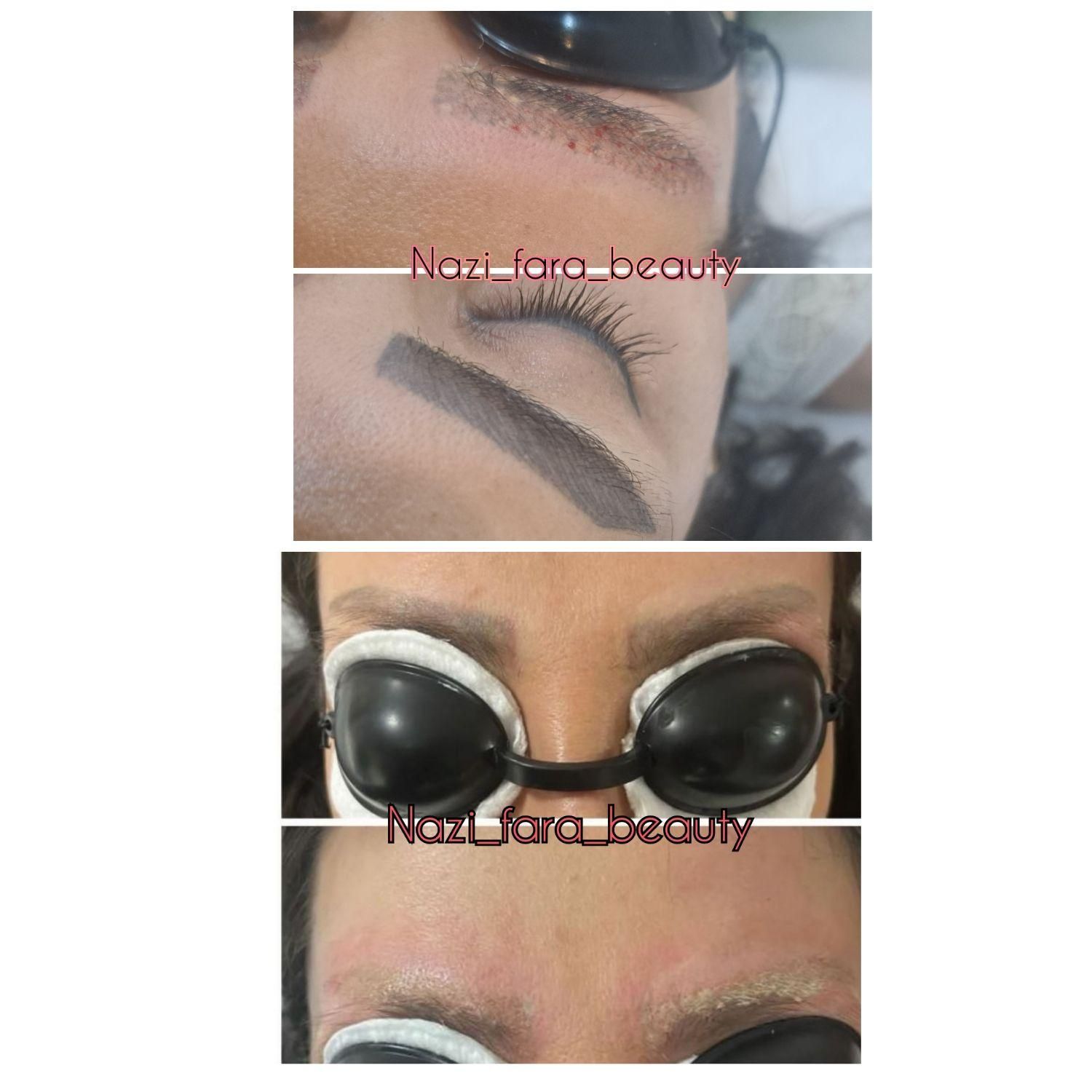مدل کربوفیشیال(کربن تراپی+فیشال+پلاژن) کلینیکی|خدمات آرایشگری و زیبایی|تهران, گاندی|دیوار