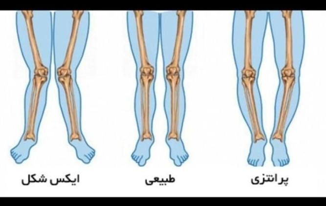 مجموعه تخصصی اصلاح ناهنجاری‌های اسکلتی|خدمات آرایشگری و زیبایی|قزوین, |دیوار