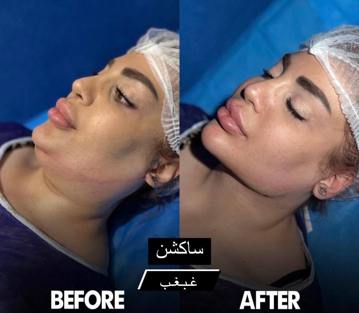 سوپرساکشن غبغب همراه بازاویه سازی تخصصی گردنُ صورت|خدمات آرایشگری و زیبایی|تهران, پاسداران|دیوار