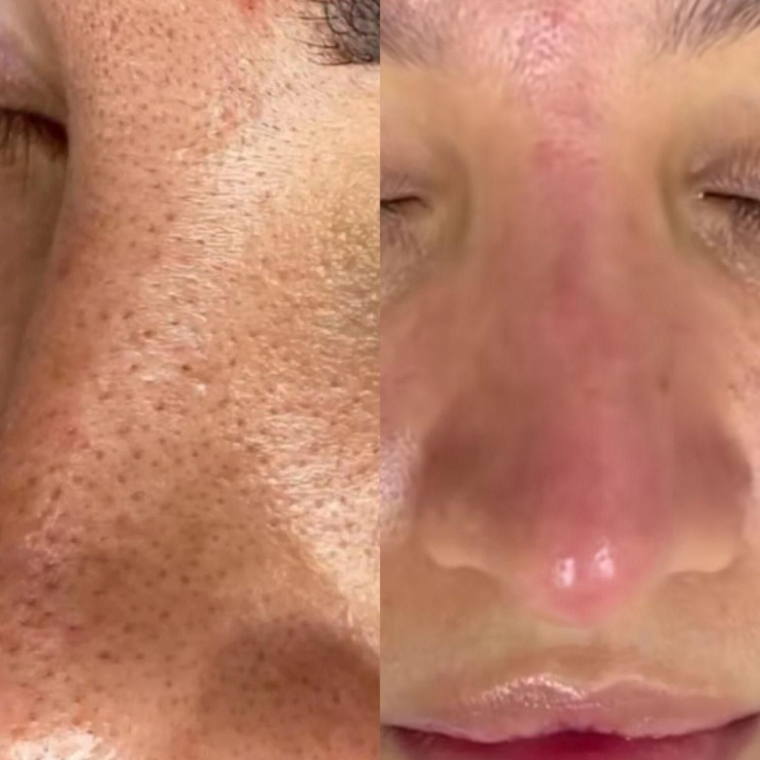 پاکسازی پوست به همراه دستگاه شروع قیمت از 280|خدمات آرایشگری و زیبایی|شیراز, کاراندیش|دیوار